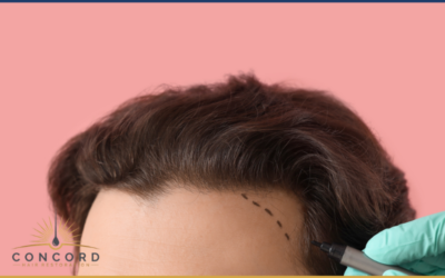 Is a Hair Transplant Worth It in Los Angeles? Cost vs Results Explained