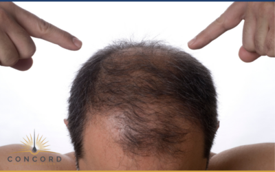 What Makes FUE Hair Transplants So Popular in Los Angeles?