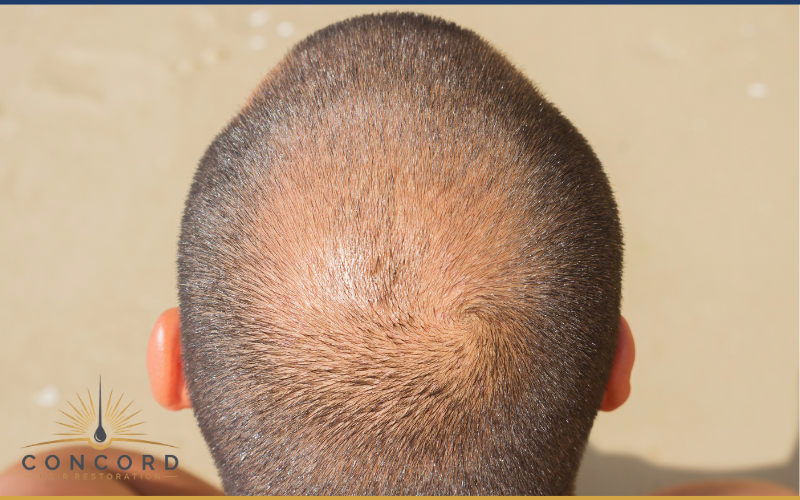 hair loss