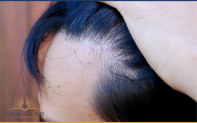 Hair Transplant Recovery Timeline: What Los Angeles Patients Should Expect