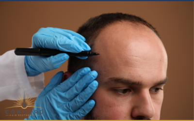 How to Choose the Best Hair Transplant Surgeon in Los Angeles