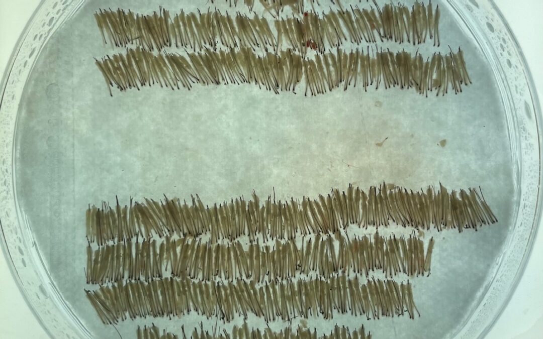 hair transplant