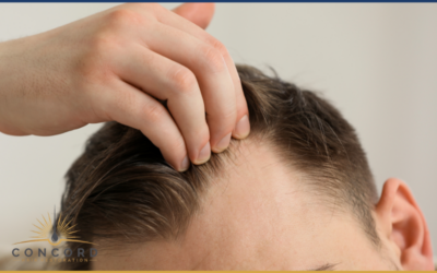 Why Hair Transplants Don’t “Fail” Overnight (And What Actually Happens)